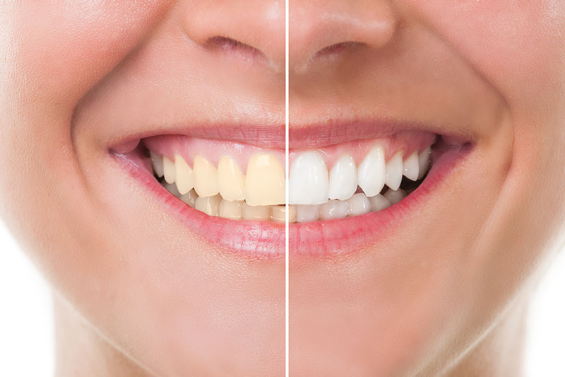 Teeth Whitening in Alhambra